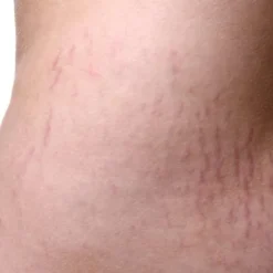 stretch-mark-cream-2023