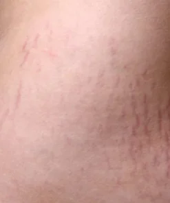 stretch-mark-cream-2023