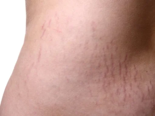 stretch-mark-cream-2023