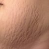 stretch mark cream price in bangladesh