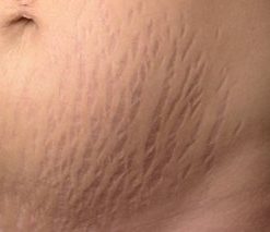 stretch mark cream price in bangladesh