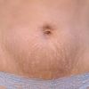 stretch-mark-cream-bd