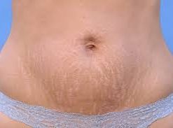 stretch-mark-cream-bd