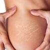 stretch-mark-cream-price