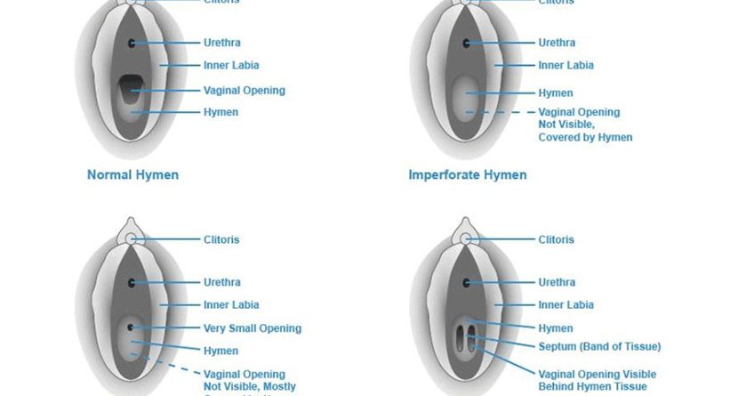 hymen-type1